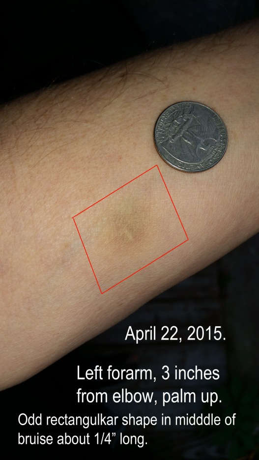 bruise april 22.jpg